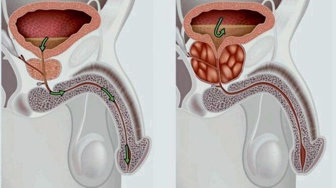 prostate saine et enflammée avec prostatite