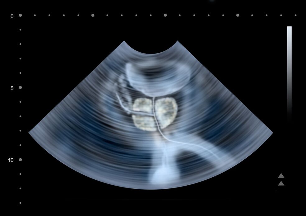 diagnostic prostatique