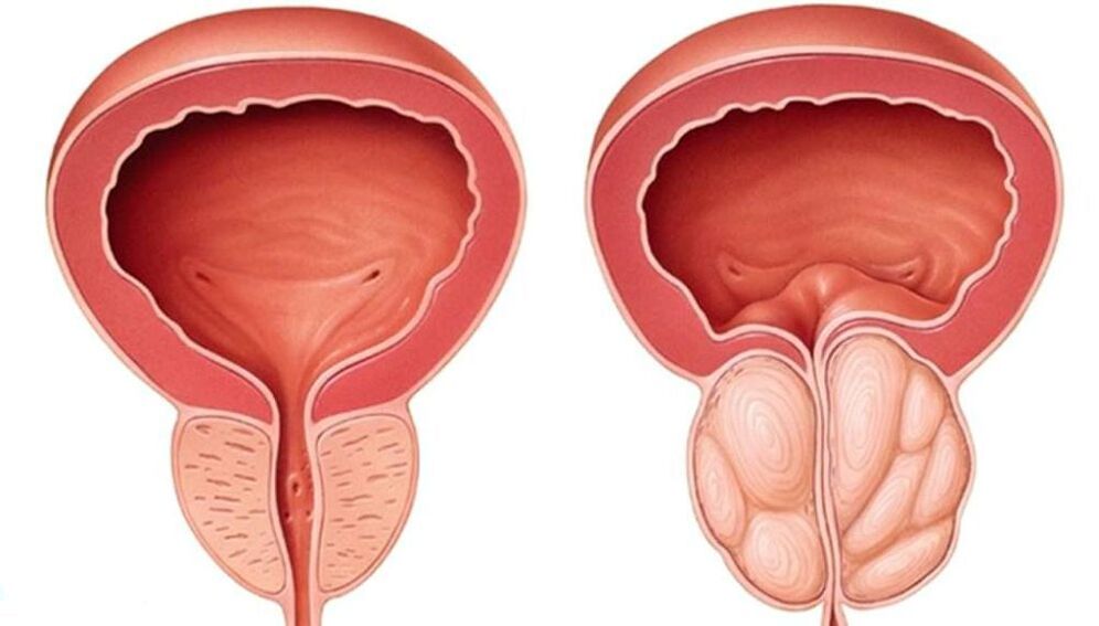 prostate normale et hypertrophiée