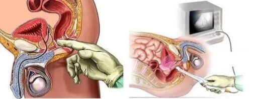 Diagnostic instrumental de la prostatite