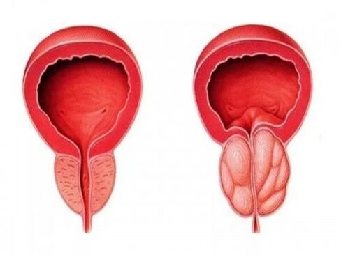 Prostate saine et enflammée